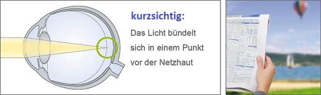 Kurzsichtigkeit (Myopie) Kurzsichtigkeit (Myopie)